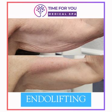 Before and after endolifting treatment showing improved skin tightness on the arm.