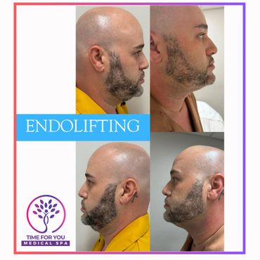 Before and after side profile photos of a man showing endolifting facial treatment results.