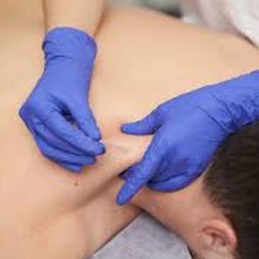 Person receiving acupuncture treatment on their back with blue gloves.