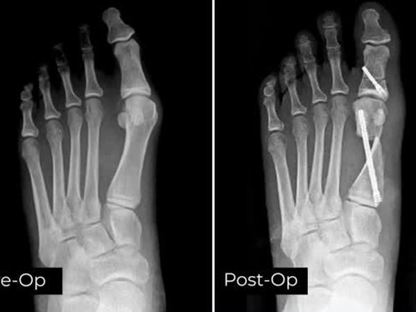 X-rays showing pre- and post-operative foot with surgical screws.