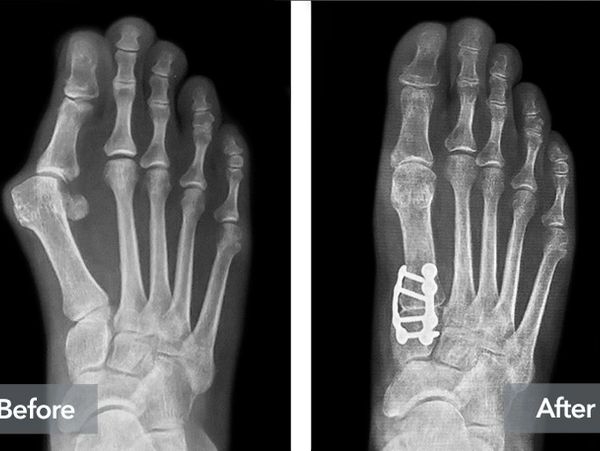X-ray images showing foot before and after surgical bone fixation.