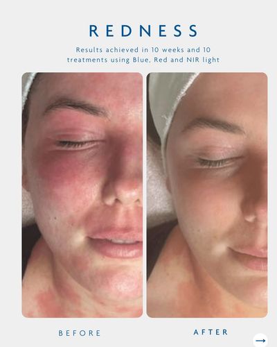 Before and after photos showing reduced facial redness after light treatment.