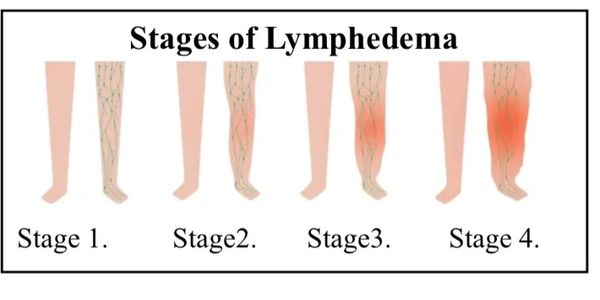 Stages of Lymphedema 