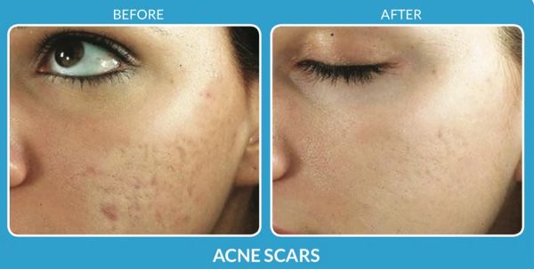 Microneedling, Chemical Peels