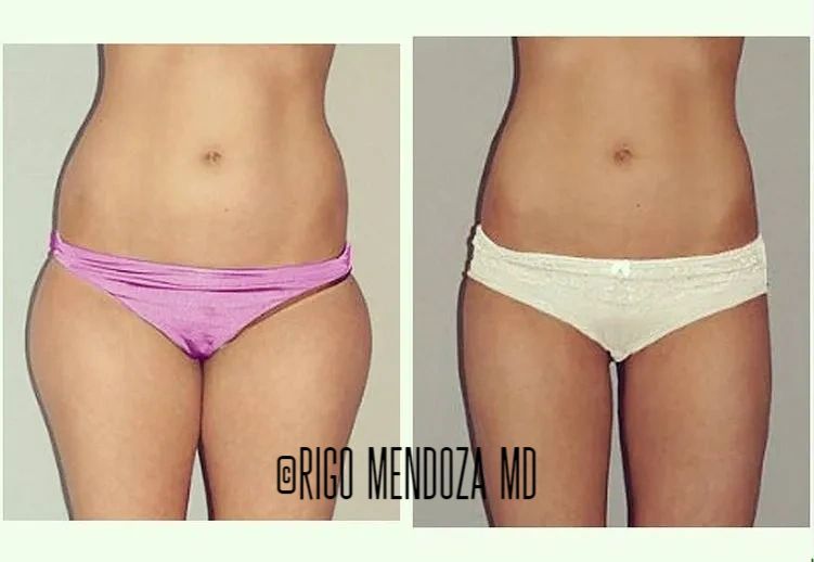 Liposuction of waist, inner and outer thighs.
