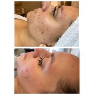 Microneedling with chemical peel 