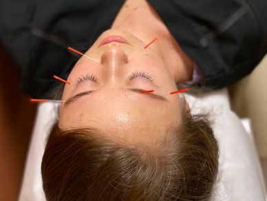 needle acupuncture treatment migraines headaches