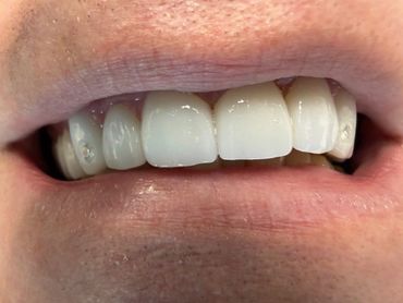 One awesome case with diamonds inserted into zirconium crowns. Not glued on, embedded into the zirco