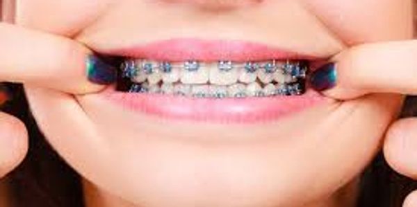 Brackets