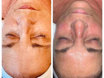 Before and After Hydrafacial CryoFacial Combination