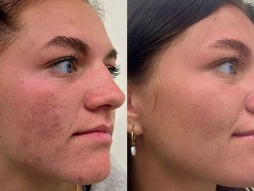 before & After
