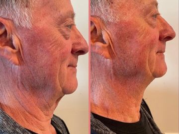 Cryo Double Chin