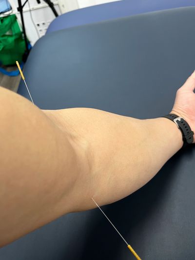 Two acupuncture needles in an elbow