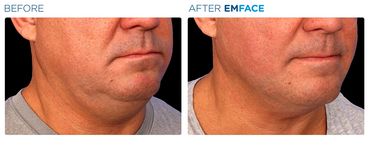 Before and after of a man’s face showing improved skin texture and firmness after Emface treatment.