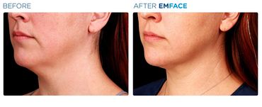Before and after, a woman’s jawline showed tighter skin and improved contour after Emface treatment.