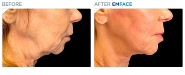 Before and after, a woman’s profile shows reduced sagging and tighter skin after Emface treatment.