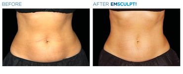 After the Emsculpt Neo treatment, the woman's abdomen displayed improved tone and reduced fat.