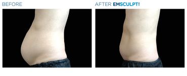 Before and after a woman’s abdomen profile shows reduced fat and better contour with Emsculpt Neo.