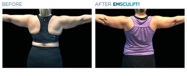 Before & after back view of a female shows reduced arm fat and better muscle tone after Emsculpt Neo