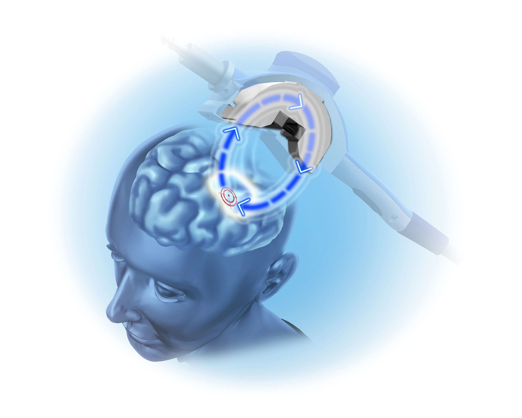 Image of TMS depression treatment wand delivering magnetic pulses to brain.