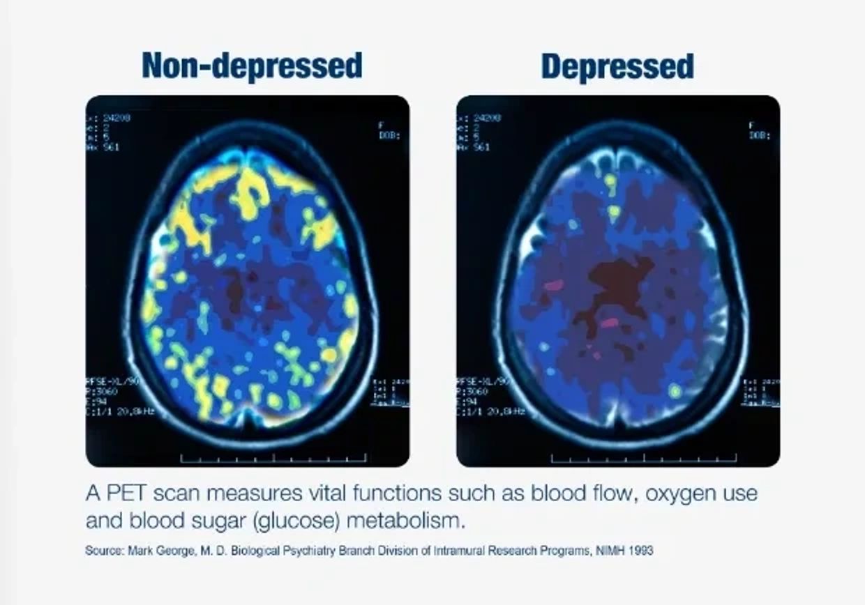 A PET scan of brain before and after TMS depression treatment.