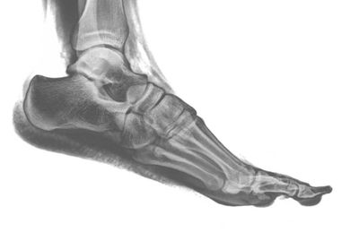 An xray of a human foot shown in profile