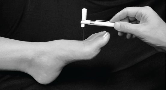 A chiropodist treats a foot with a medical instrument