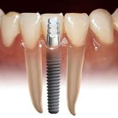 photo of titanium dental implant