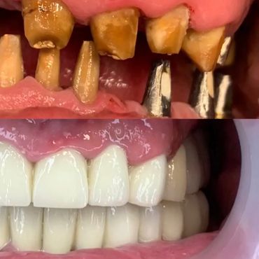impianti dentali e corone in zirconia albania