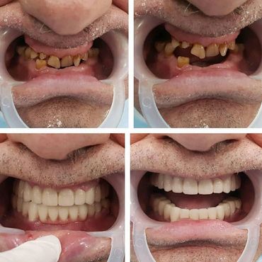 impianti dentali e corone in zirconia albania