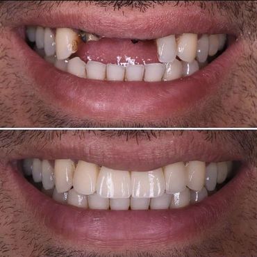 impianti dentali e corone in zirconia albania