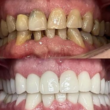 impianti dentali e corone in zirconia albania