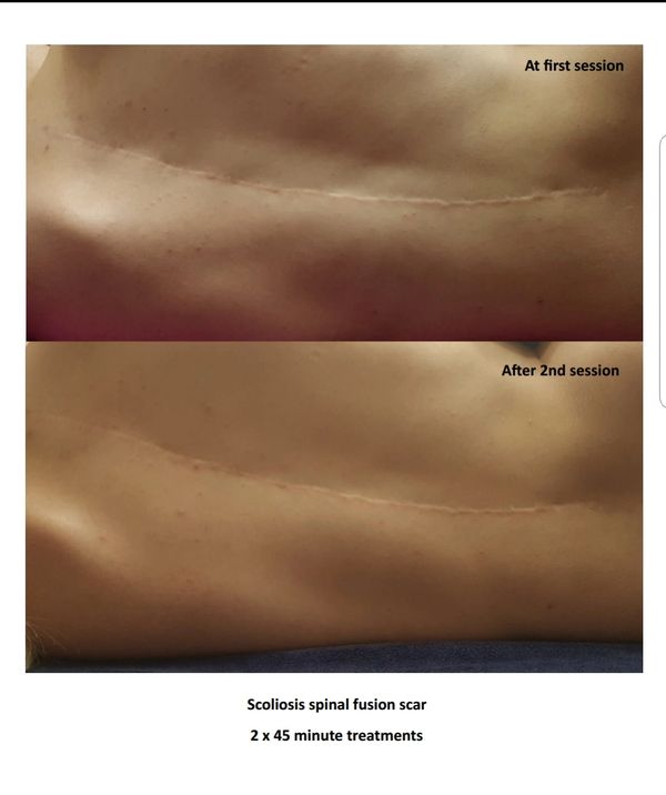 Spinal Fusion Scar before and after ScarWork