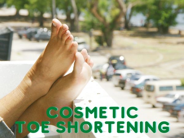 Cosmetic Toe Shortening. Morton's Toe Correction. Long Second Toe