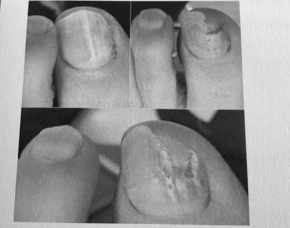 Nail reconstruction treatment at Village Podiatrists, Wombourne