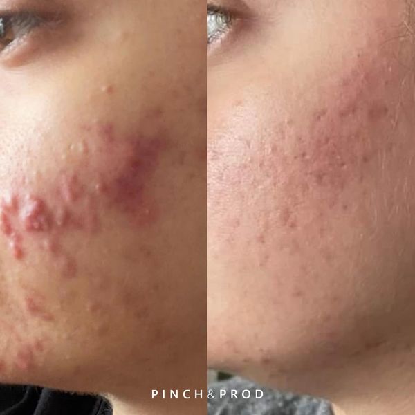 acne treatement before and after