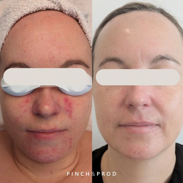 sensitive skin treatment before and after