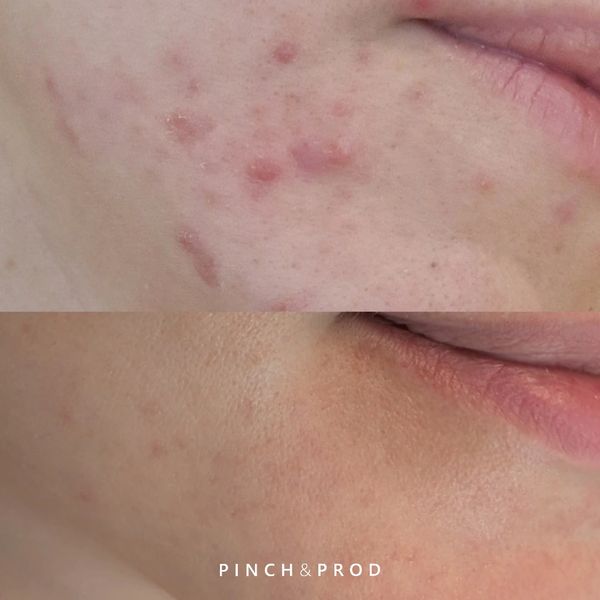 acne pigment before and after