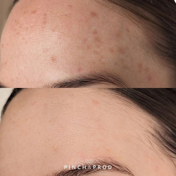 skin pigmentation before and after