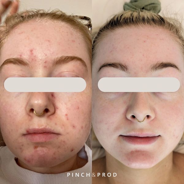 facial acne before and after