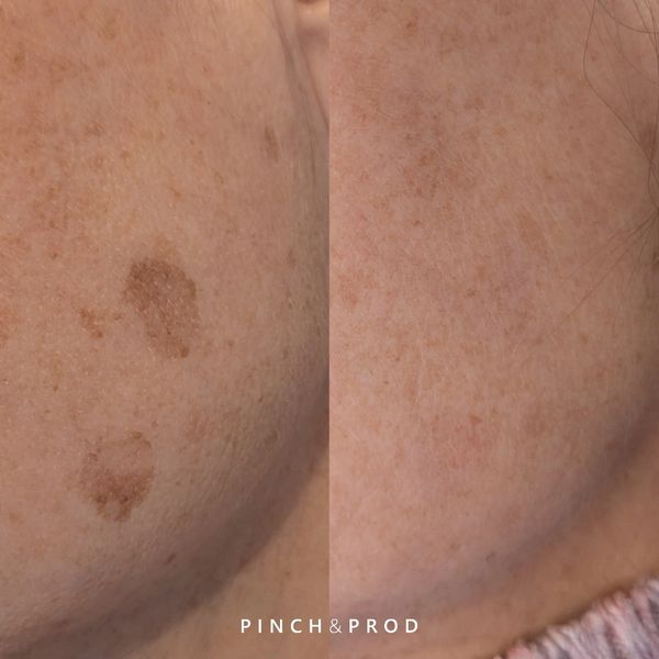 face pigment before and after