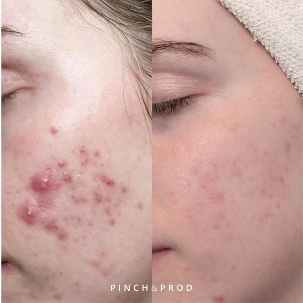face acne before and after