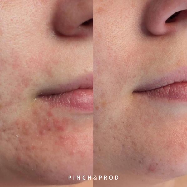 Perioral dermatitis before and after