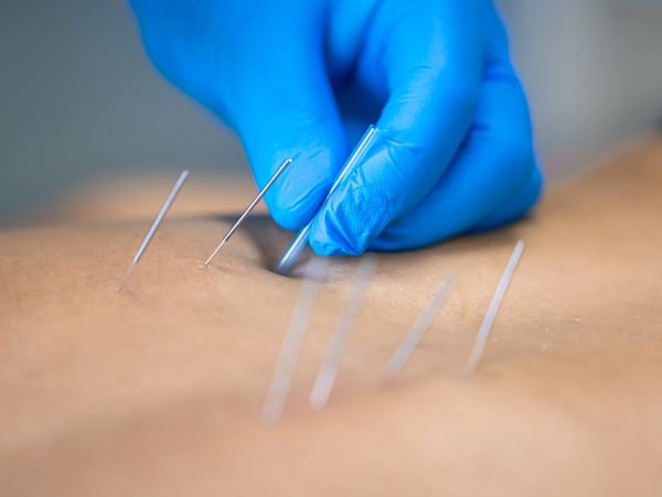 Close-up of acupuncture needles inserted in skin during treatment.