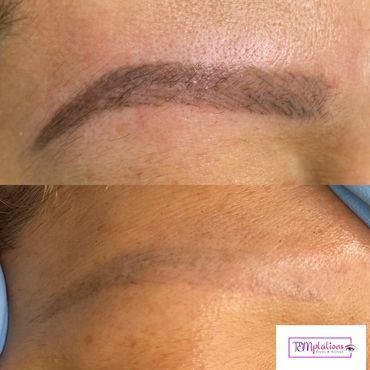 Saline microblading removal near me