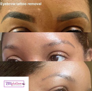 Permanent make up removal near me