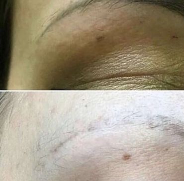 Microblading saline removal near me.