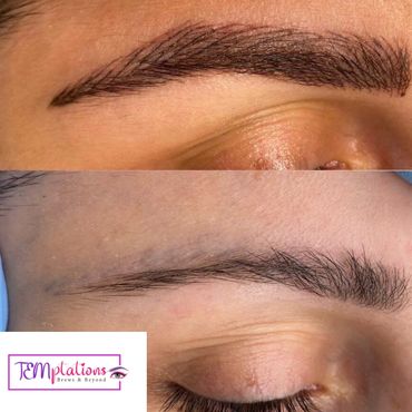 Saline removal in Williamsport pa