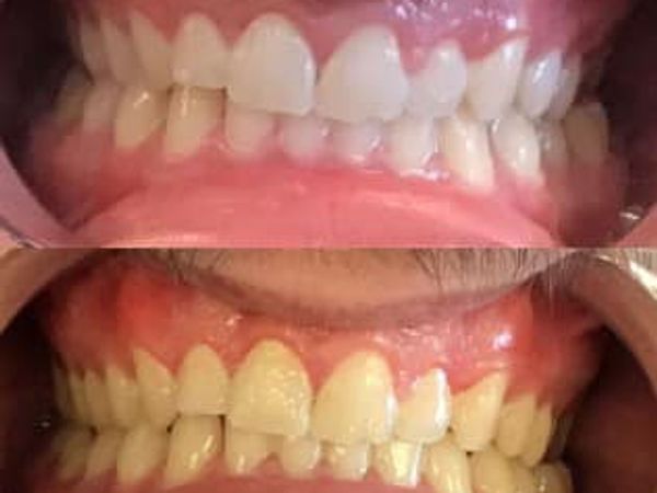Teeth whitening up to 14 shades lighter near hughesville pa