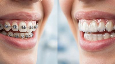 Side-by-side comparison of metal braces and clear aligners on teeth.